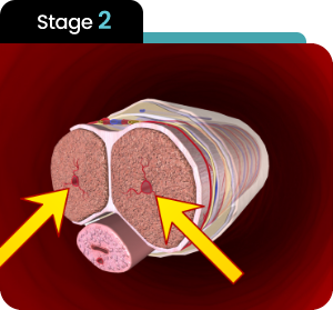 Stage 2 anatomical illustration used to explain the Soda Peak blood-flow process