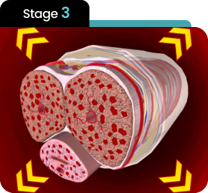 Stage 3 anatomical blood-flow illustration used in the Soda Peak male enhancement explanation